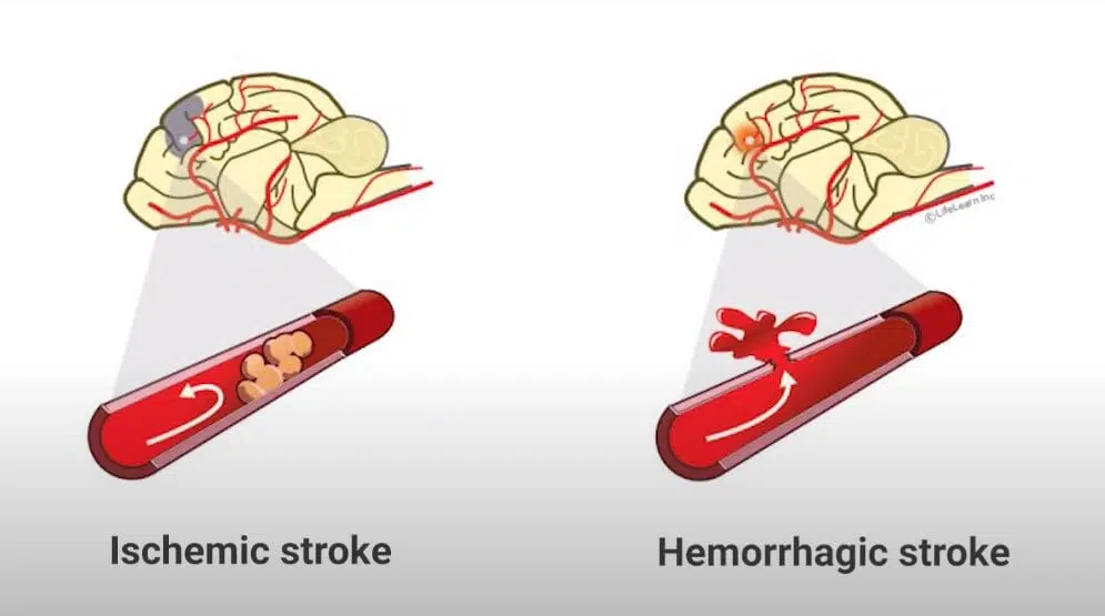 Types of strokes